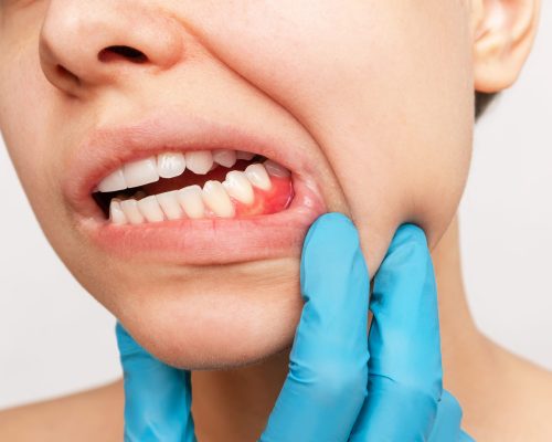 Gum inflammation. Cropped shot of a young woman’s face with doct Gum inflammation. Cropped shot of a young woman's face with doct