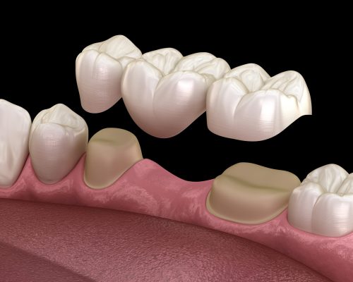 Dental bridge of 3 teeth over molar and premolar. Medically accurate 3D illustration of human teeth treatment Dental bridge of 3 teeth over molar and premolar. Medically accurate 3D illustration of human teeth treatment